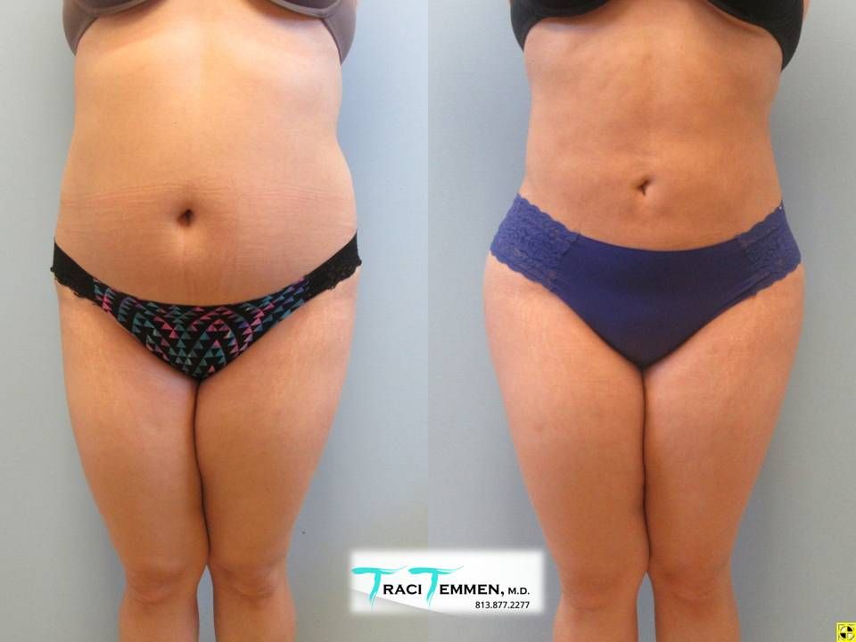 Brazilian Butt Lift Before & After