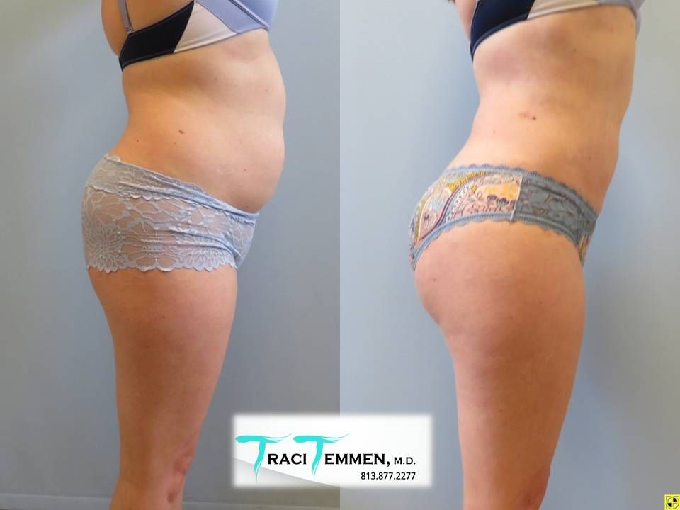 Brazilian Butt Lift Before & After