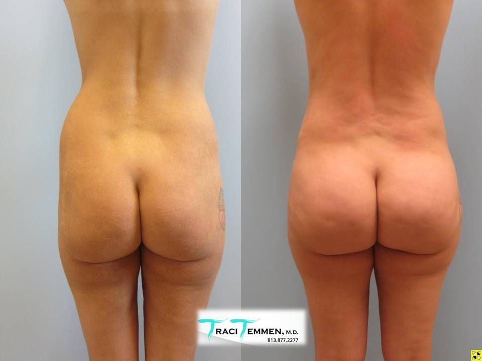 Brazilian Butt Lift Before & After
