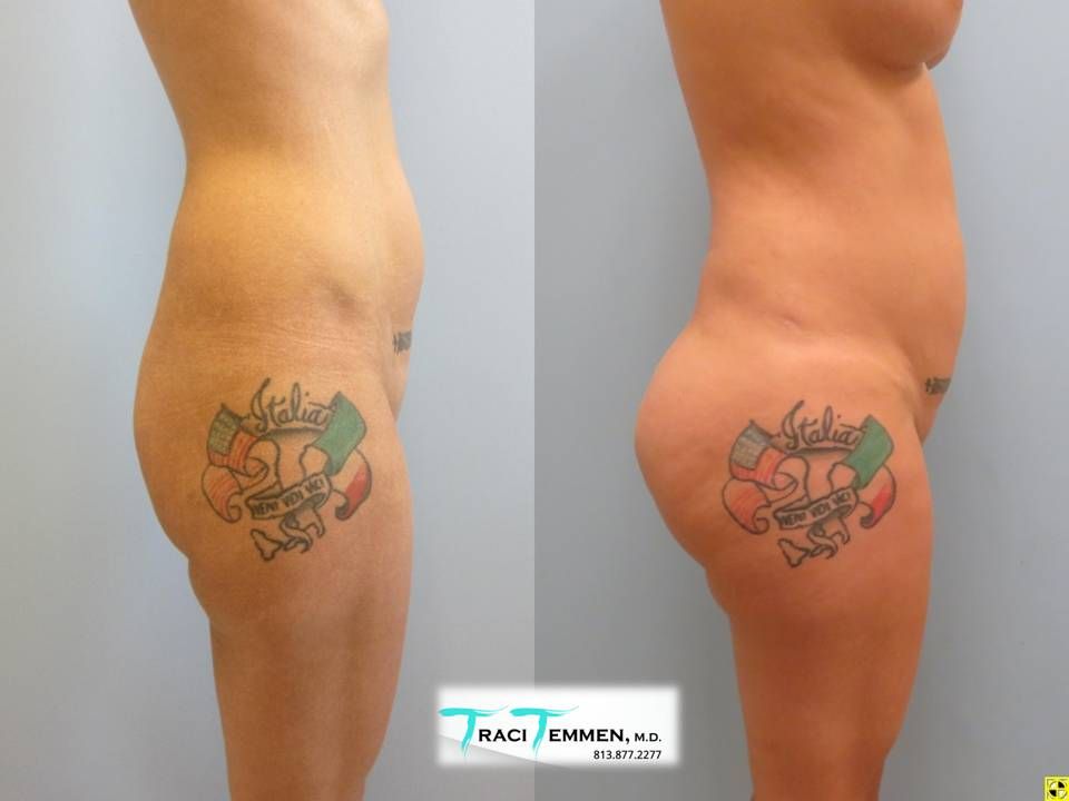 Brazilian Butt Lift Before & After