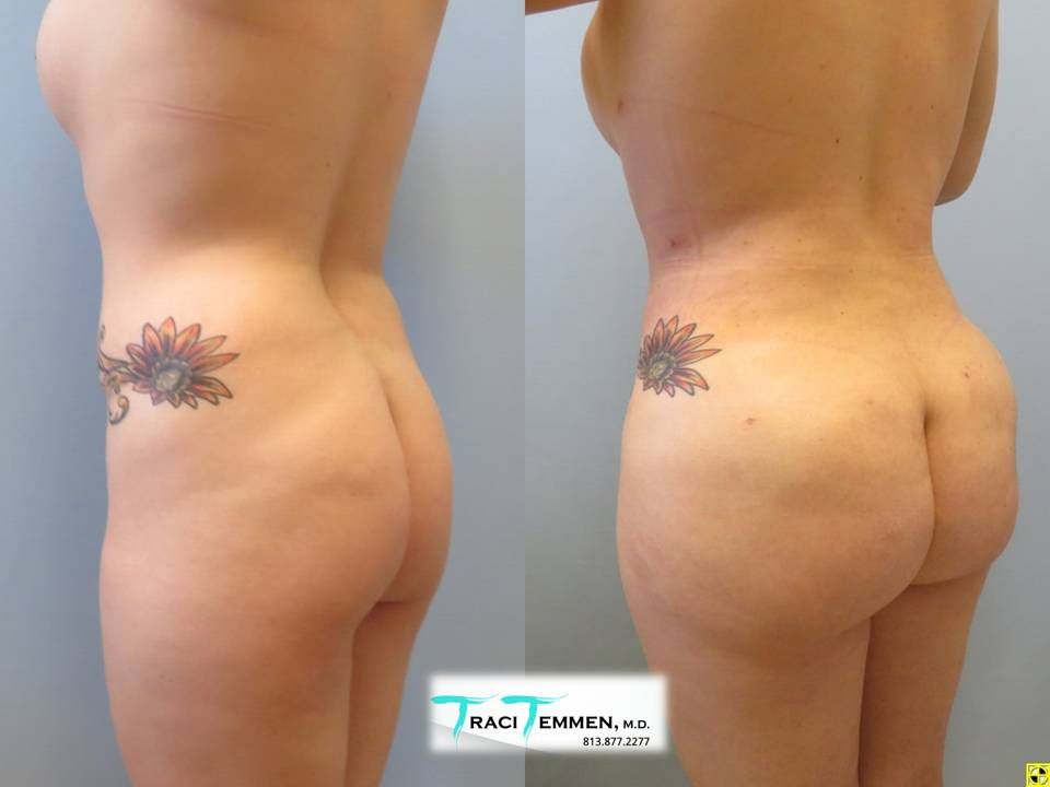 Brazilian Butt Lift Before & After