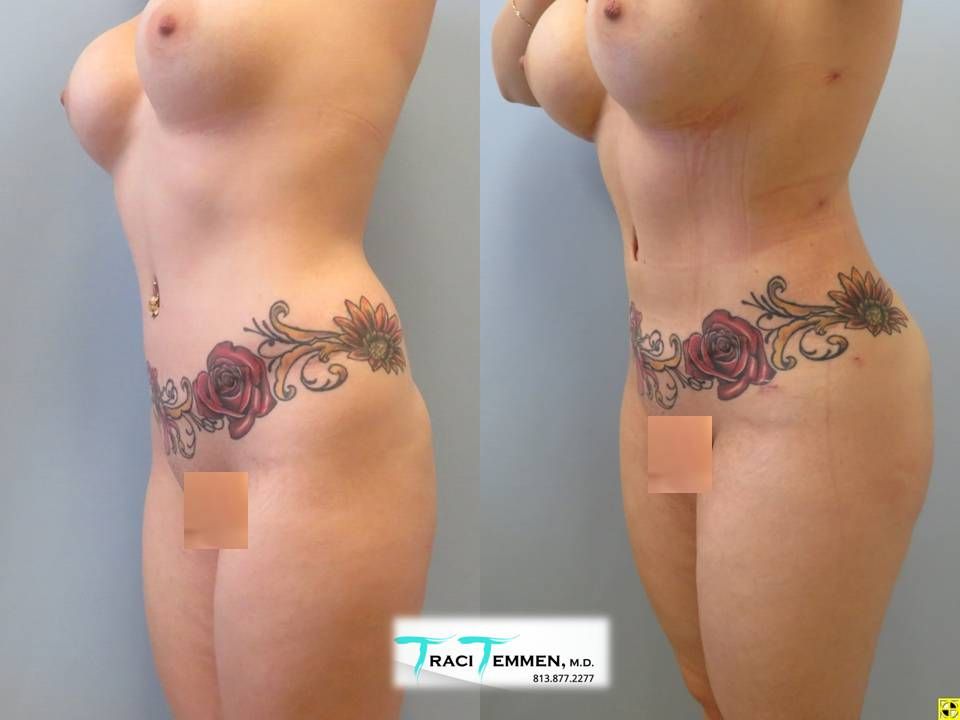 Brazilian Butt Lift Before & After