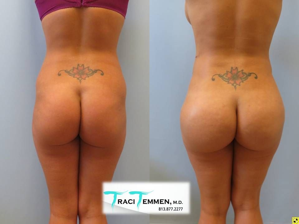 Brazilian Butt Lift Before & After