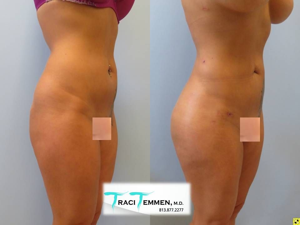 Brazilian Butt Lift Before & After