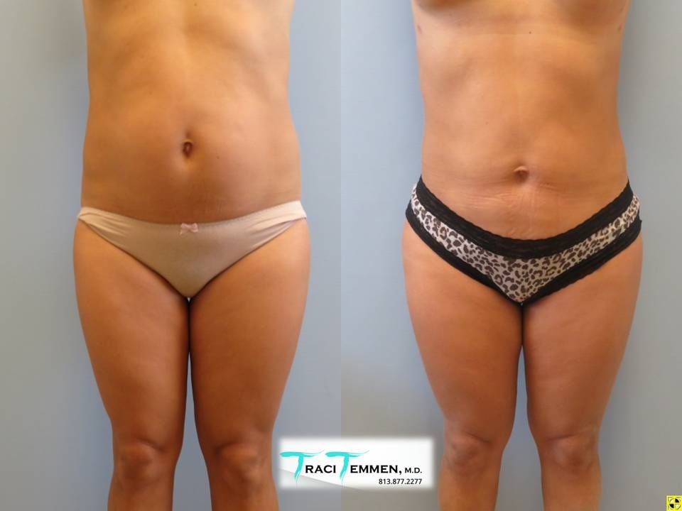 Brazilian Butt Lift Before & After