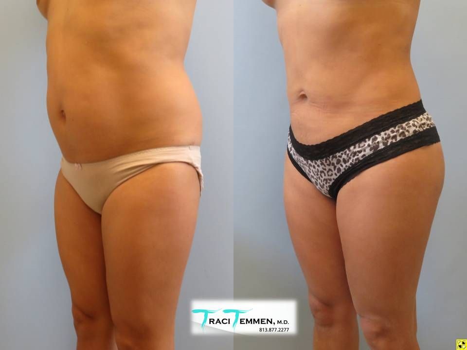 Brazilian Butt Lift Before & After