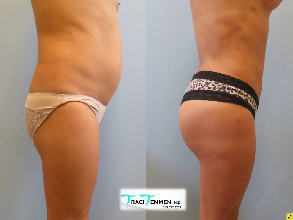 Brazilian Butt Lift Before & After