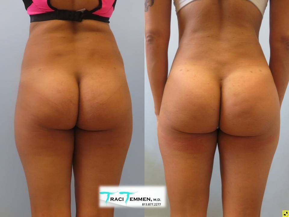 Brazilian Butt Lift Before & After