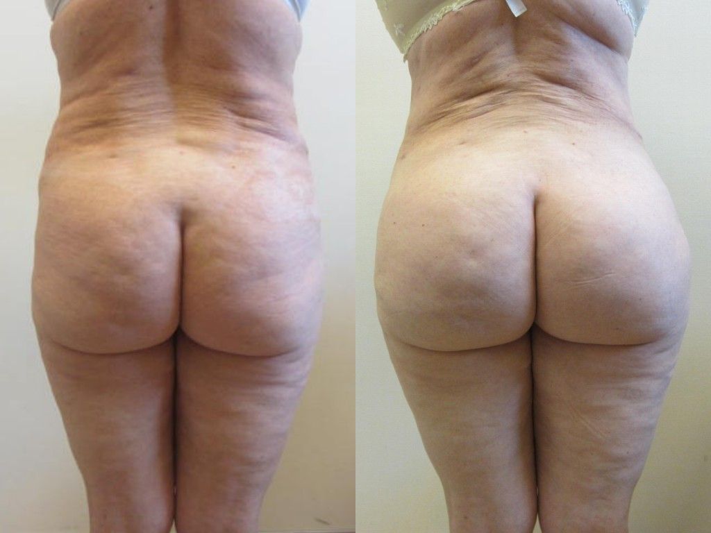Brazilian Butt Lift Before & After