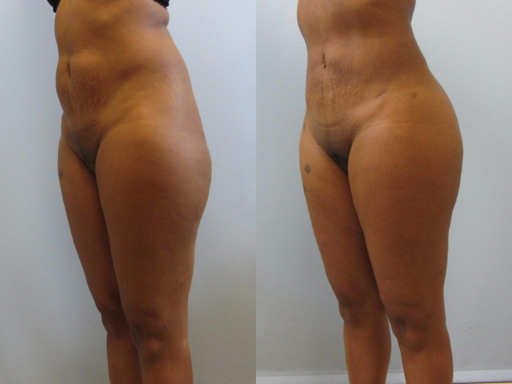 Brazilian Butt Lift Before & After
