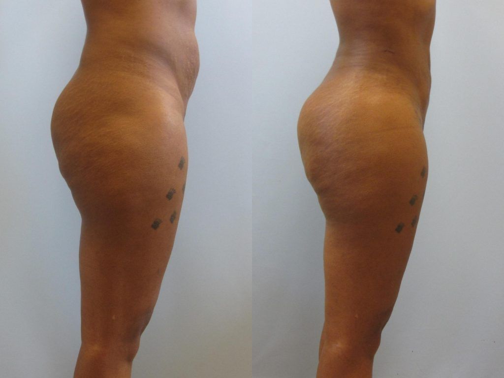 Brazilian Butt Lift Before & After