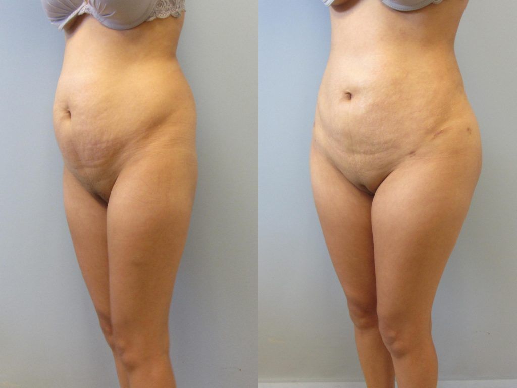 Brazilian Butt Lift Before & After