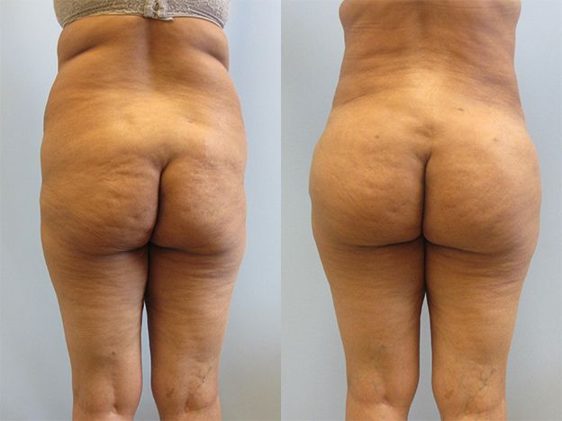 Brazilian Butt Lift Before & After