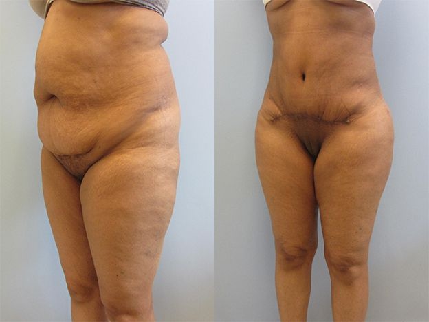 Brazilian Butt Lift Before & After