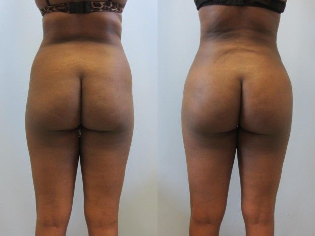 Brazilian Butt Lift Before & After