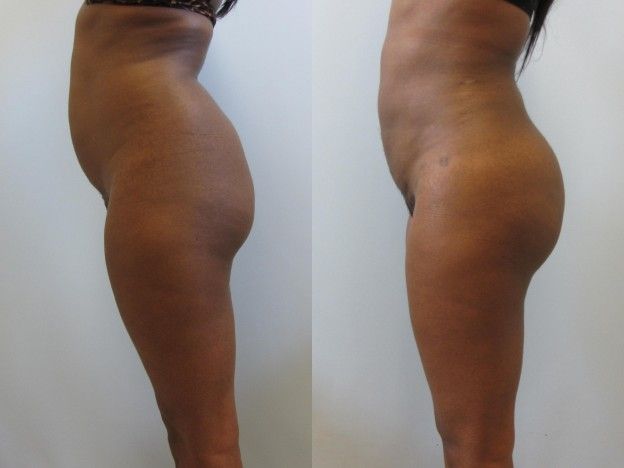 Brazilian Butt Lift Before & After