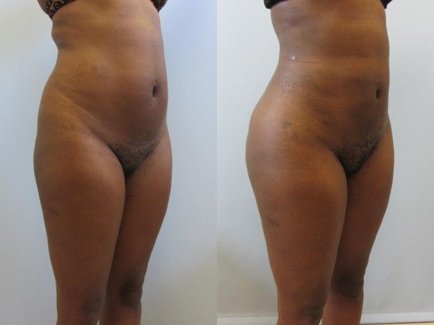 Brazilian Butt Lift Before & After