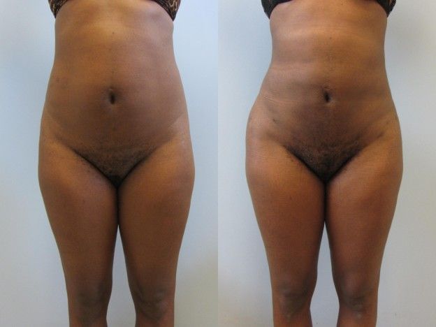 Brazilian Butt Lift Before & After