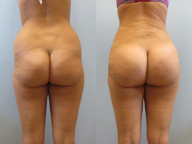 Brazilian Butt Lift Before & After