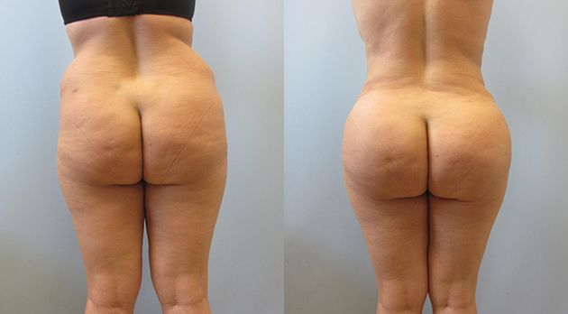 Brazilian Butt Lift Before & After