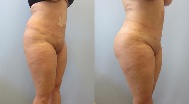 Brazilian Butt Lift Before & After