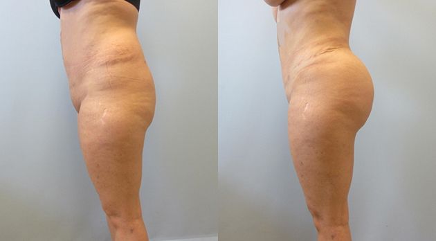 Brazilian Butt Lift Before & After