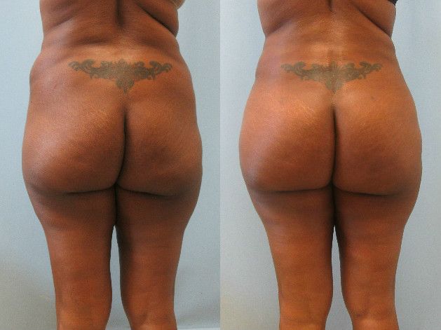 Brazilian Butt Lift Before & After