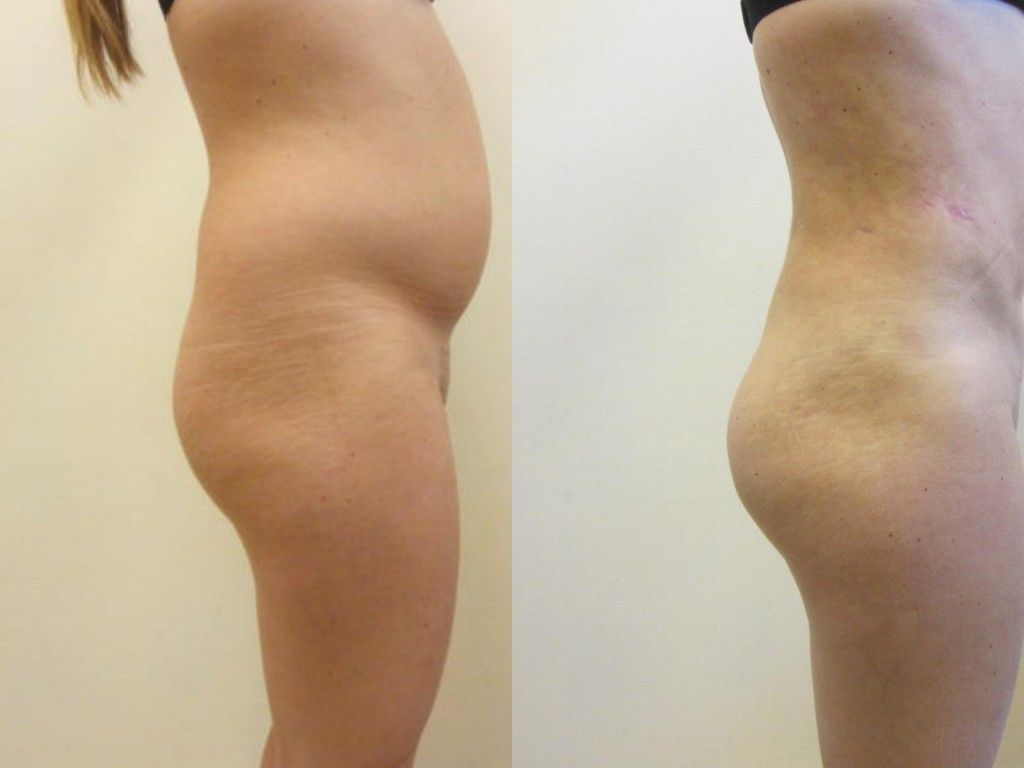 Brazilian Butt Lift Before & After
