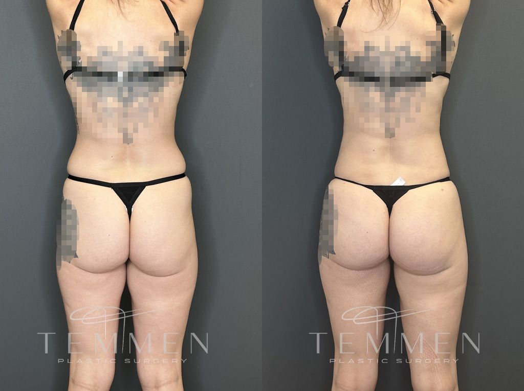 Brazilian Butt Lift Before & After
