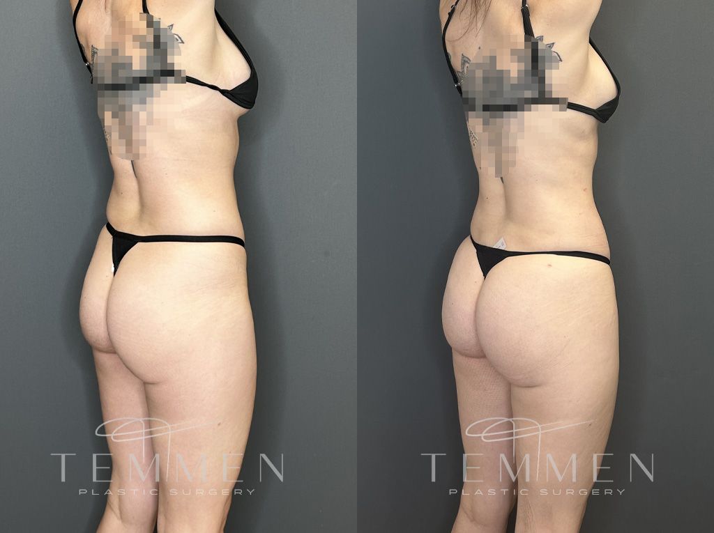 Brazilian Butt Lift Before & After
