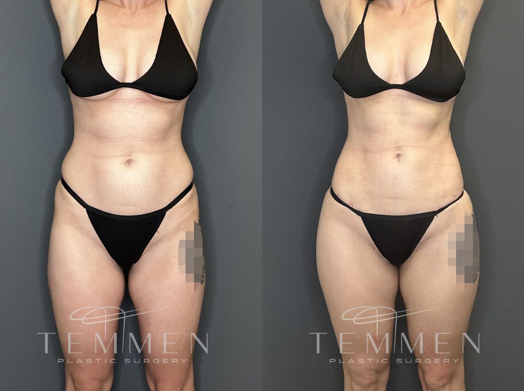 Brazilian Butt Lift Before & After