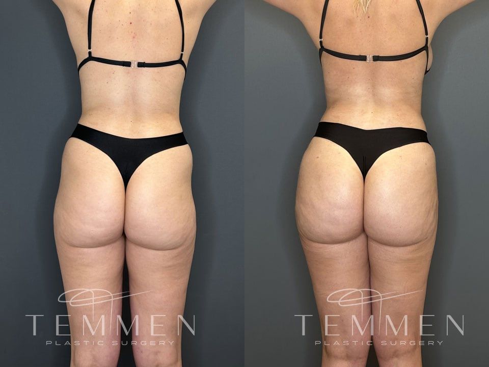 Brazilian Butt Lift Before & After