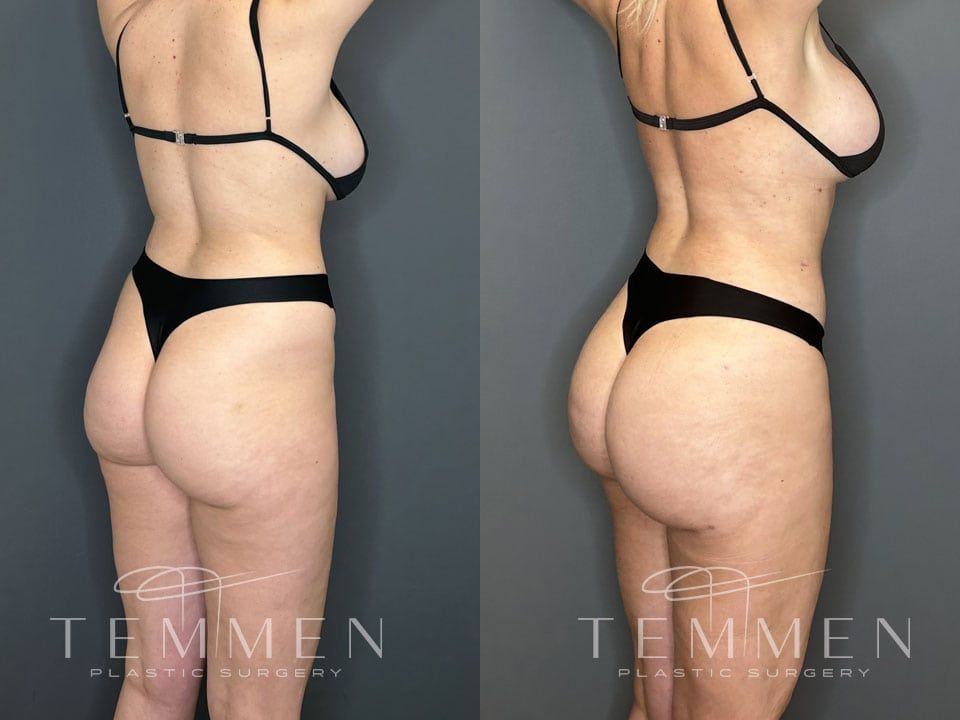 Brazilian Butt Lift Before & After