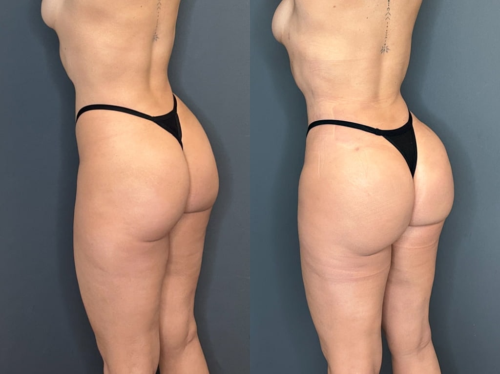 Brazilian Butt Lift Before & After