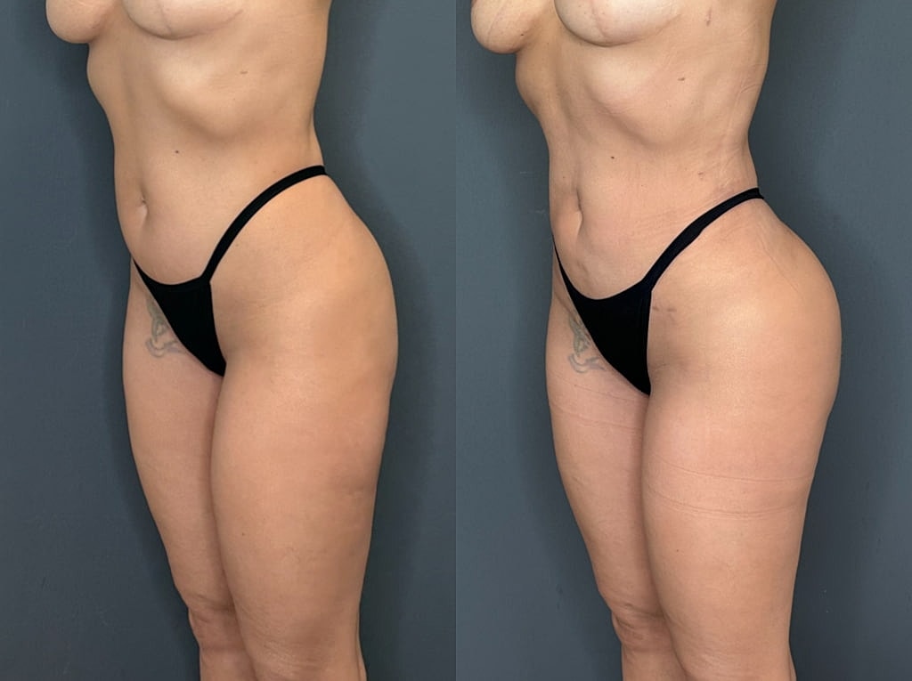 Brazilian Butt Lift Before & After
