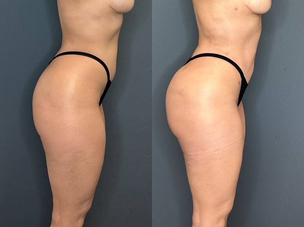 Brazilian Butt Lift Before & After