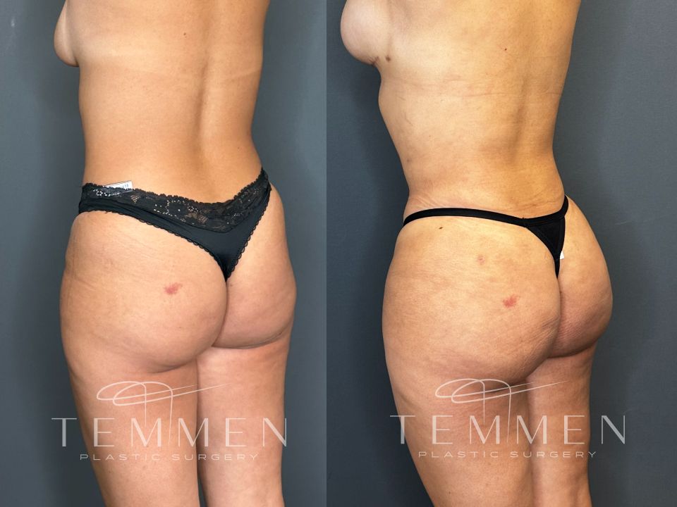 Brazilian Butt Lift Before & After
