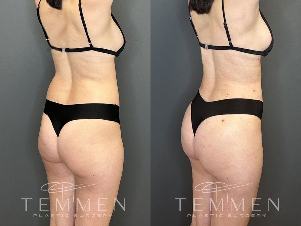 Brazilian Butt Lift Before & After