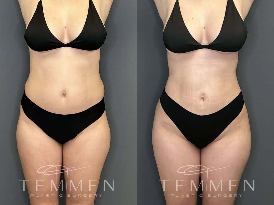 Brazilian Butt Lift Before & After