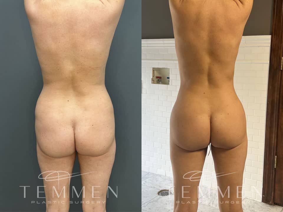 Brazilian Butt Lift Before & After