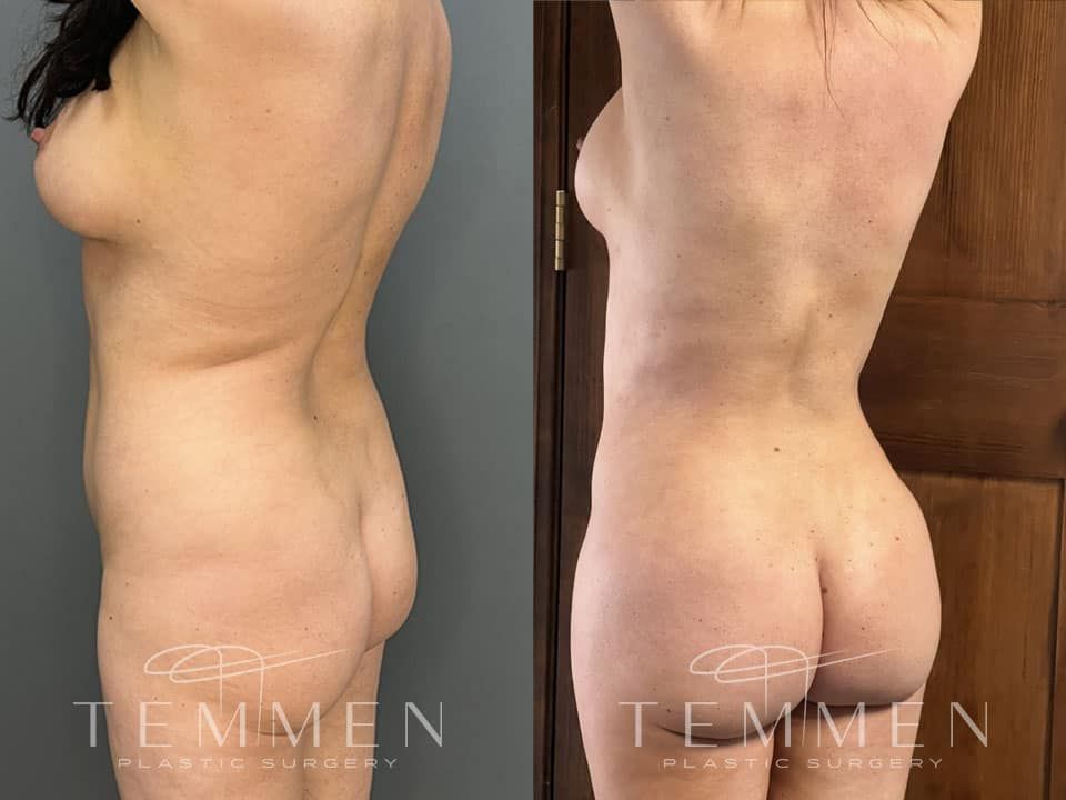 Brazilian Butt Lift Before & After