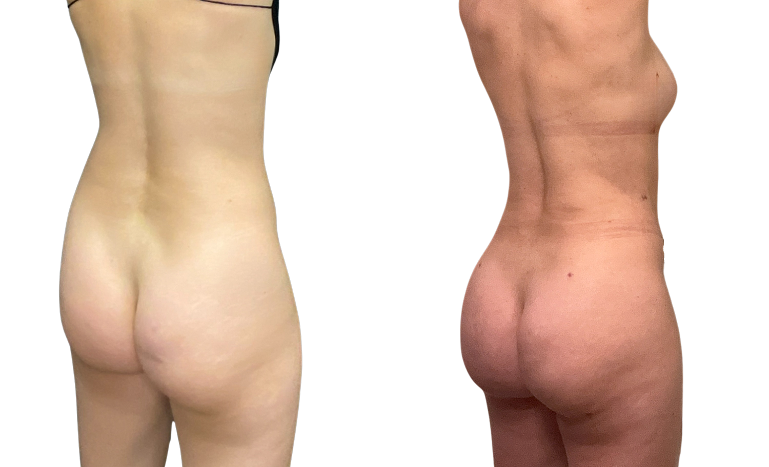 Brazilian Butt Lift Before & After