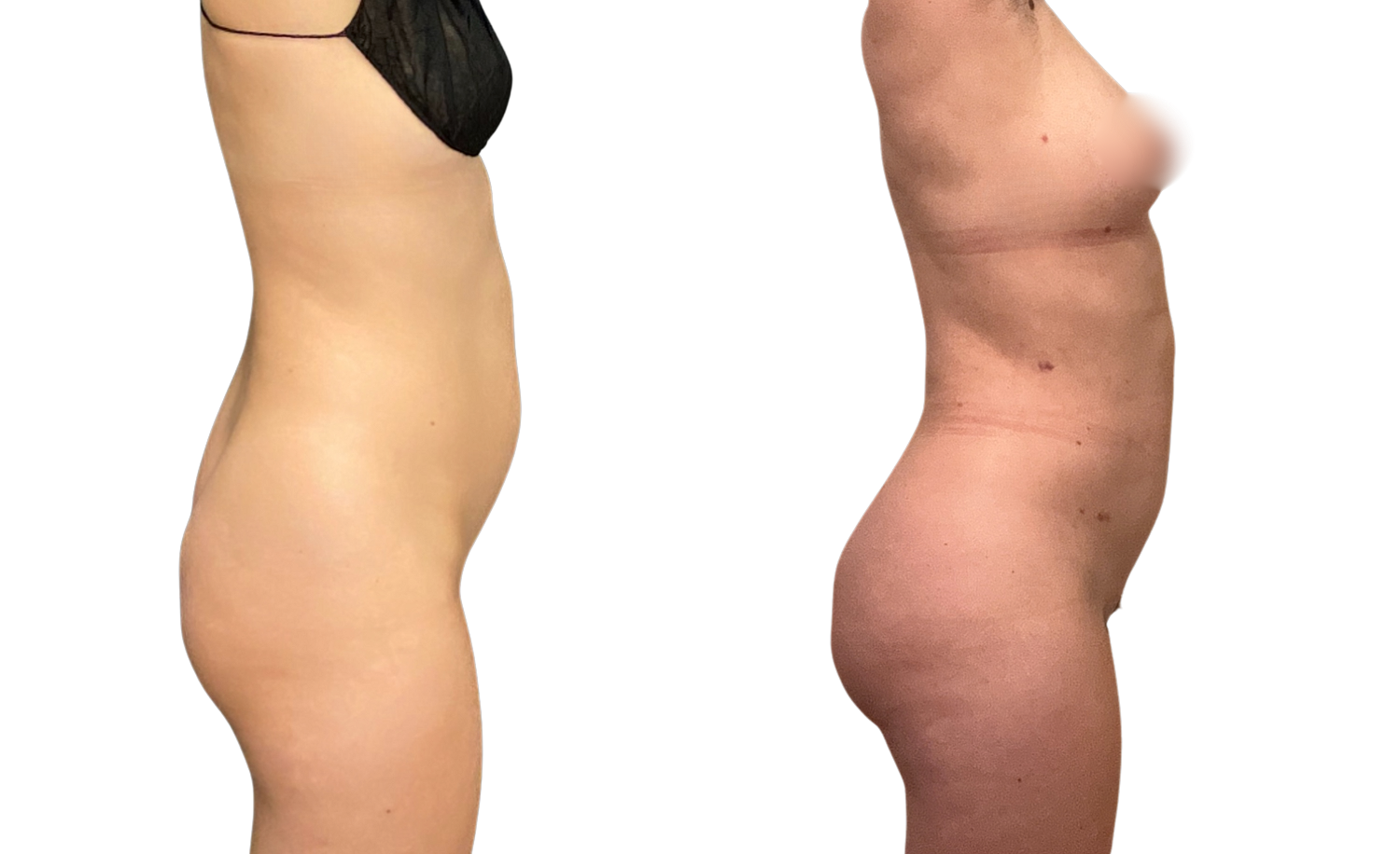 Brazilian Butt Lift Before & After
