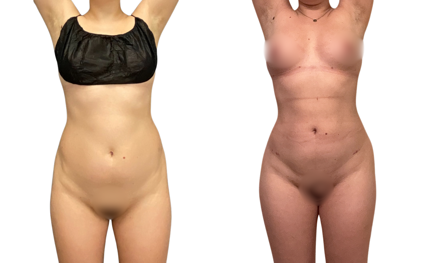 Brazilian Butt Lift Before & After