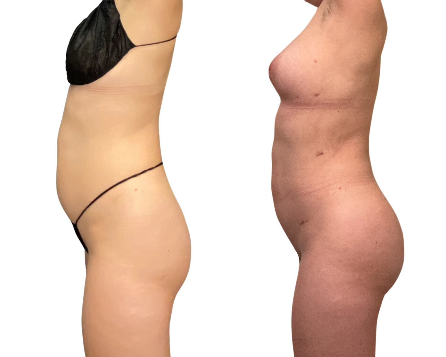 Brazilian Butt Lift Before & After