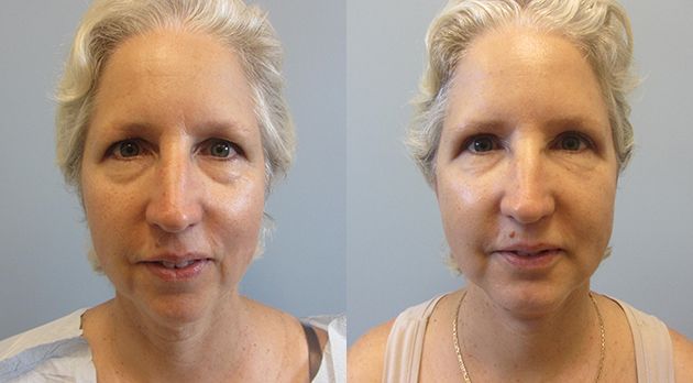 Face Lift Before & After