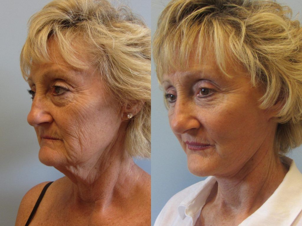 Face Lift Before & After