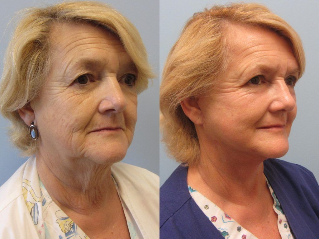 Face Lift Before & After