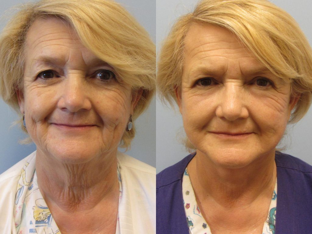 Face Lift Before & After
