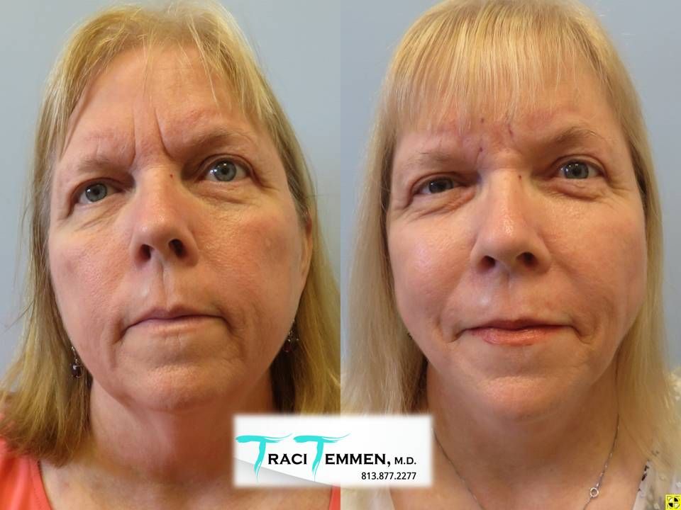 Face Lift Before & After